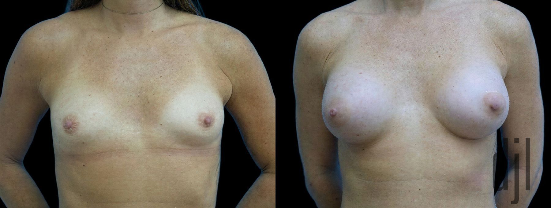 Before and after Breast Augmentation case 42949
