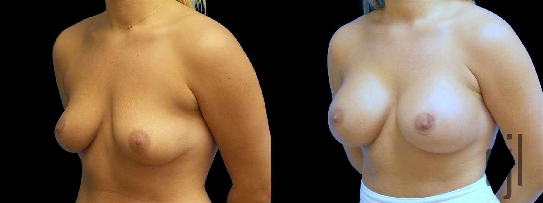 Before and after Breast Augmentation case 42961 - Angle 2
