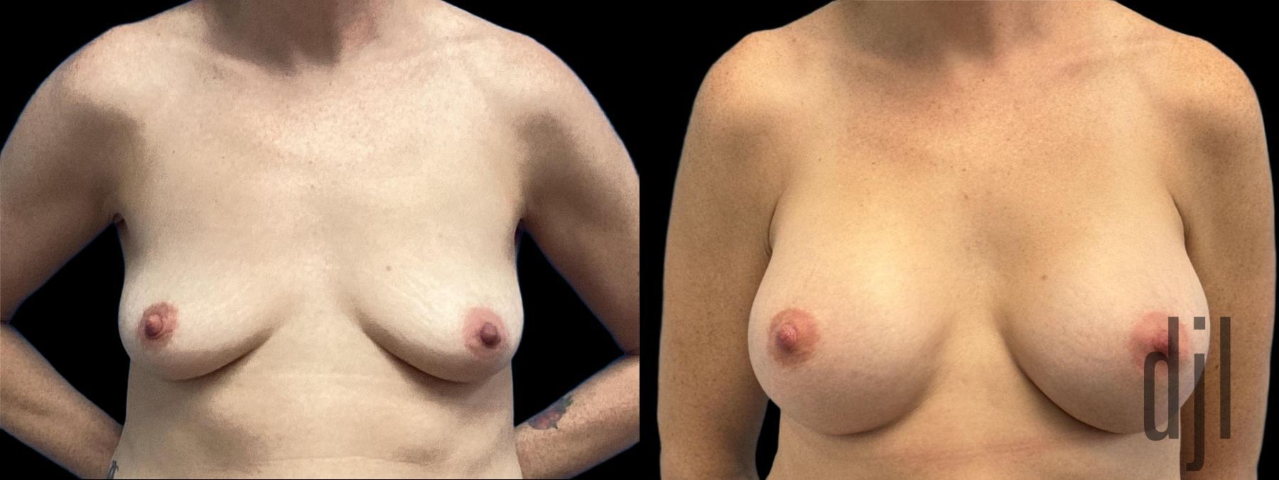 Before and after Breast Augmentation case 33057