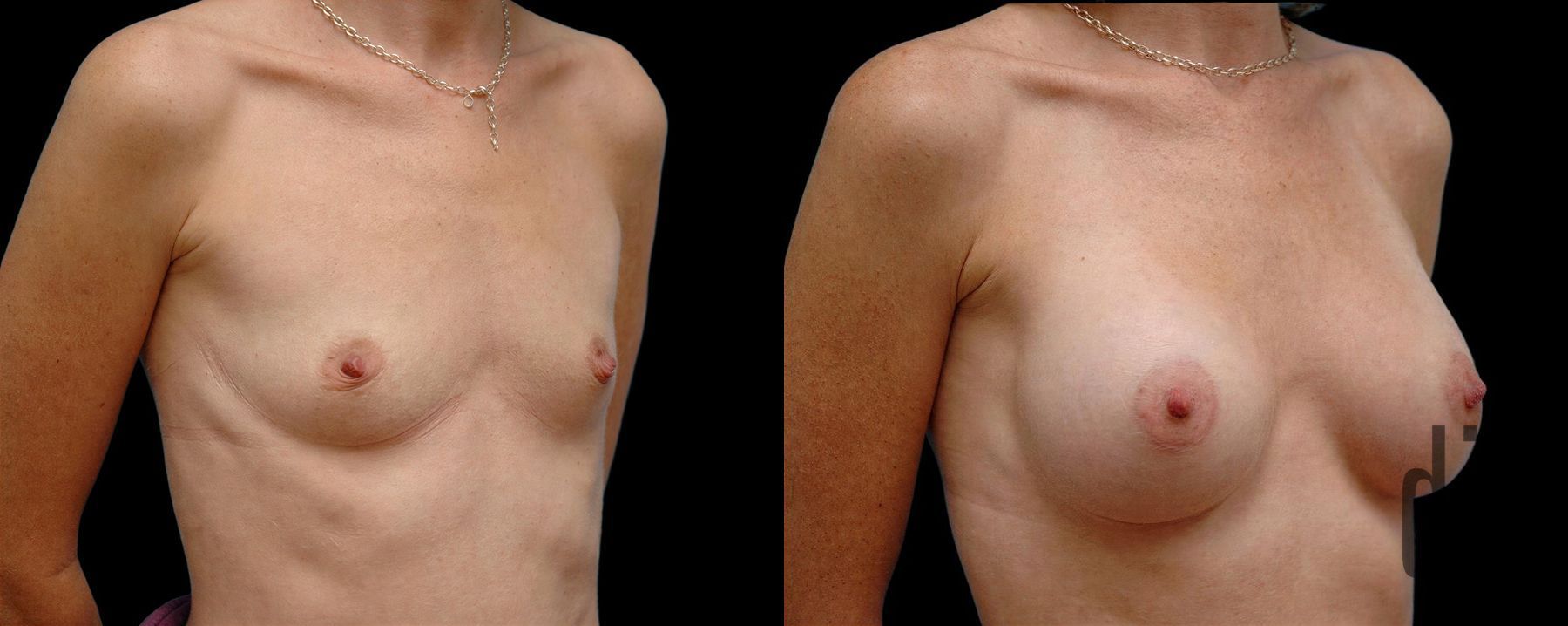 Before and after Breast Augmentation case 42744 - Angle 2