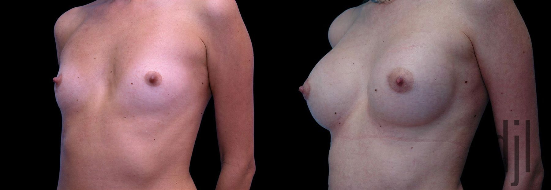 Before and after Breast Augmentation case 42679 - Angle 2