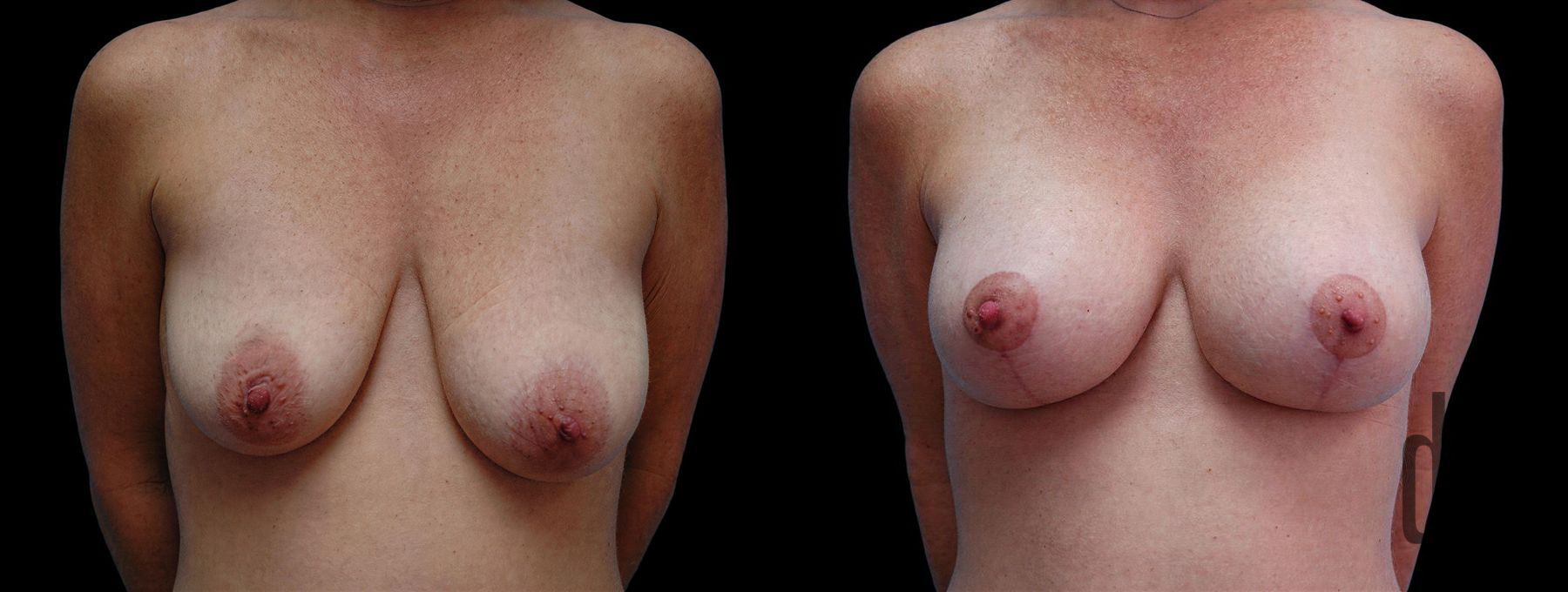 Before and after Breast Augmentation with Lift case 42545
