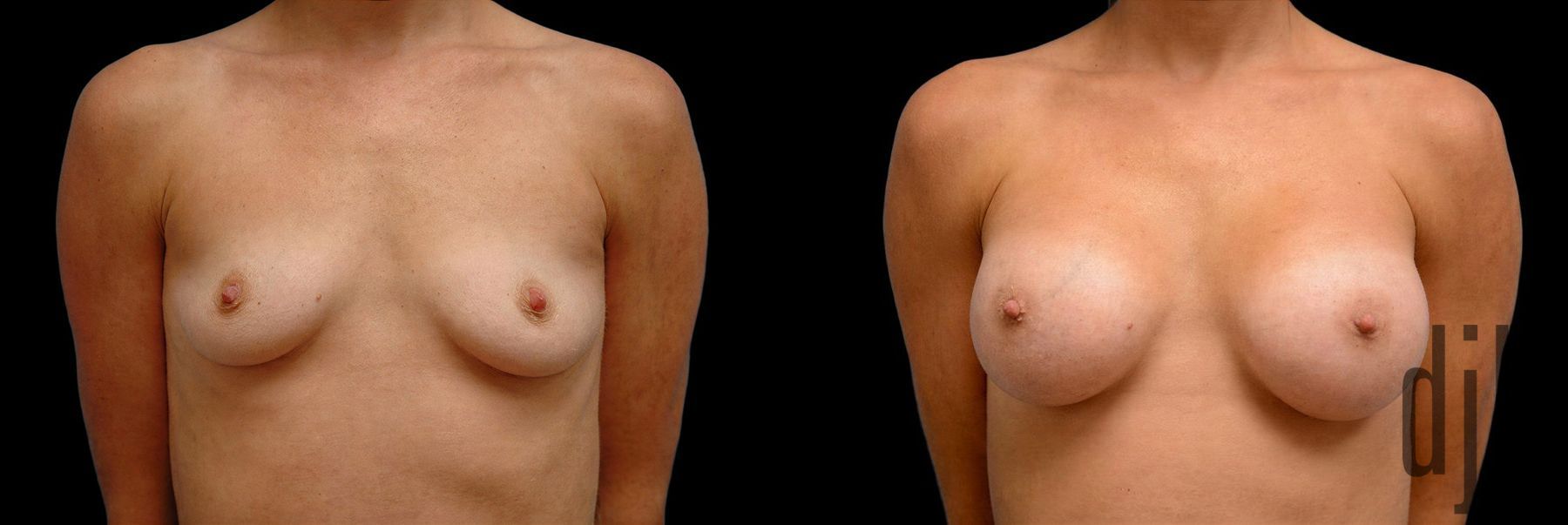 Before and after Breast Augmentation case 42783