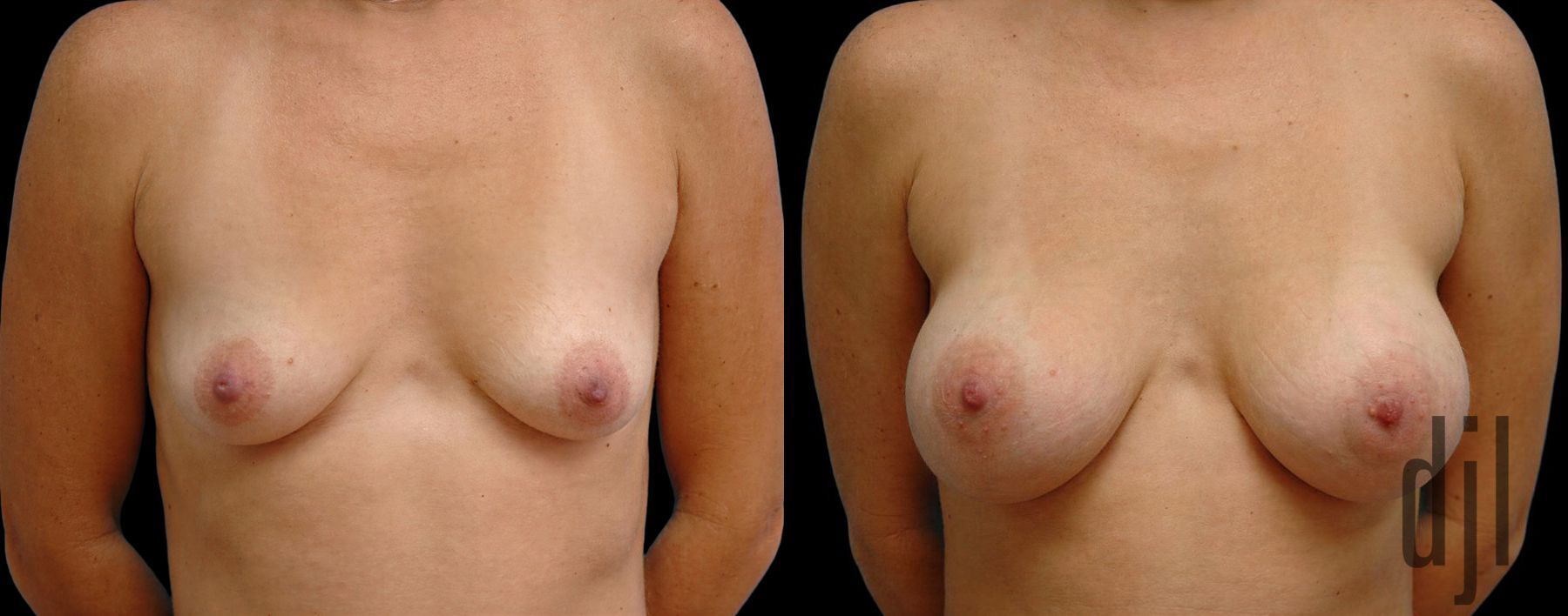Before and after Breast Augmentation case 42623