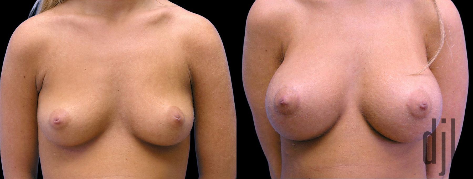 Before and after Breast Augmentation case 42929