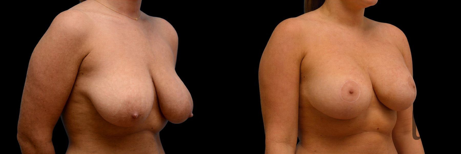 Before and after Breast Augmentation with Lift case 42738 - Angle 2