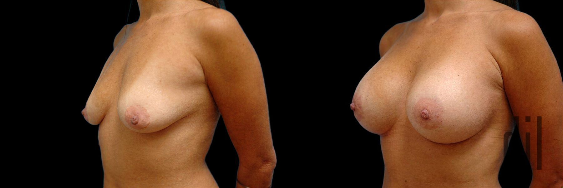 Before and after Breast Augmentation case 42755 - Angle 2