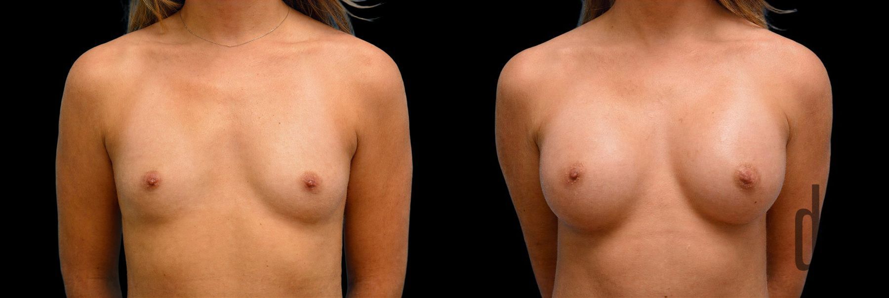 Before and after Breast Augmentation case 42843