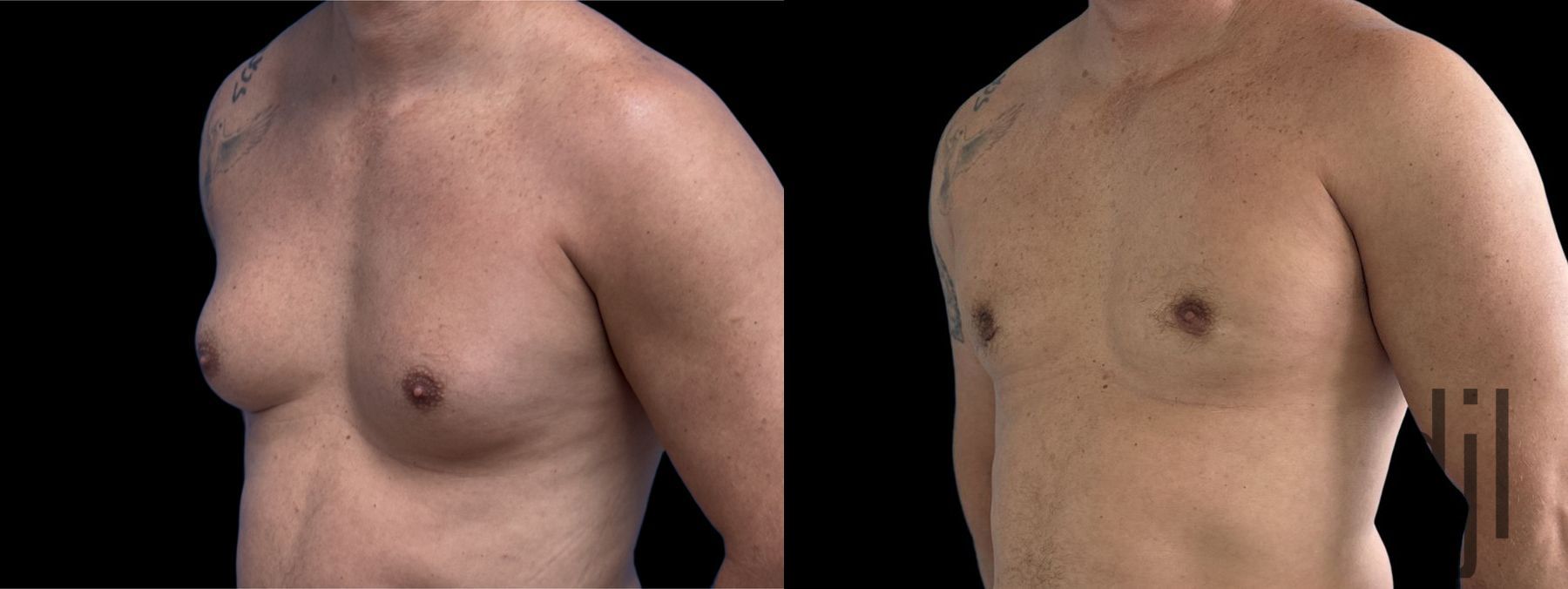 Before and after Gynecomastia case 33063 - Angle 2