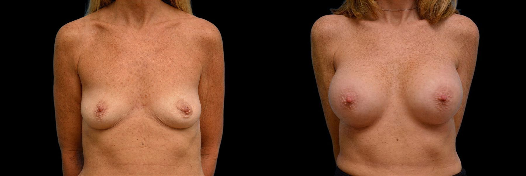 Before and after Breast Augmentation case 42888