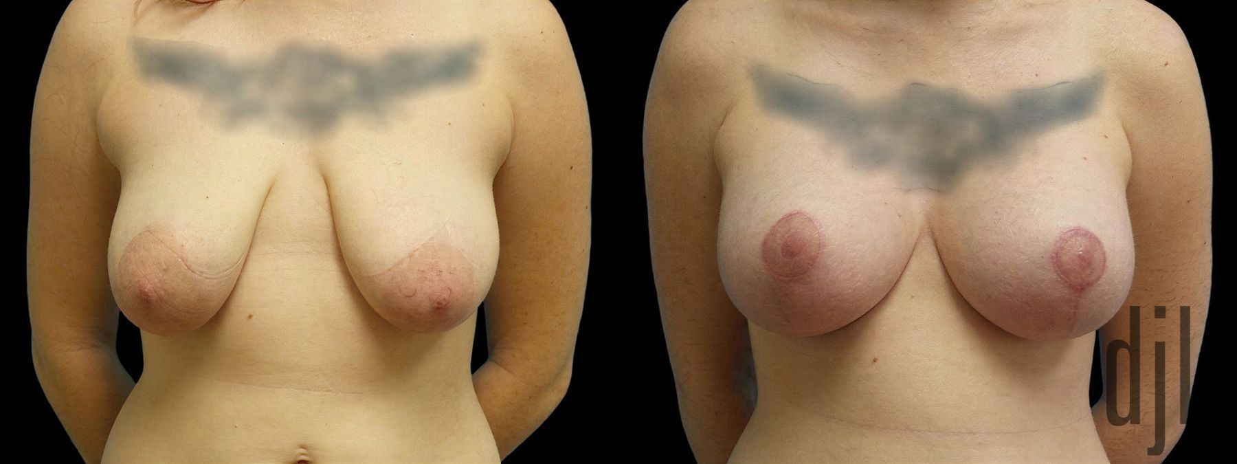Before and after Breast Augmentation with Lift case 42955