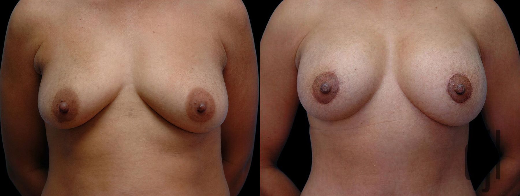 Before and after Breast Augmentation with Lift case 42564