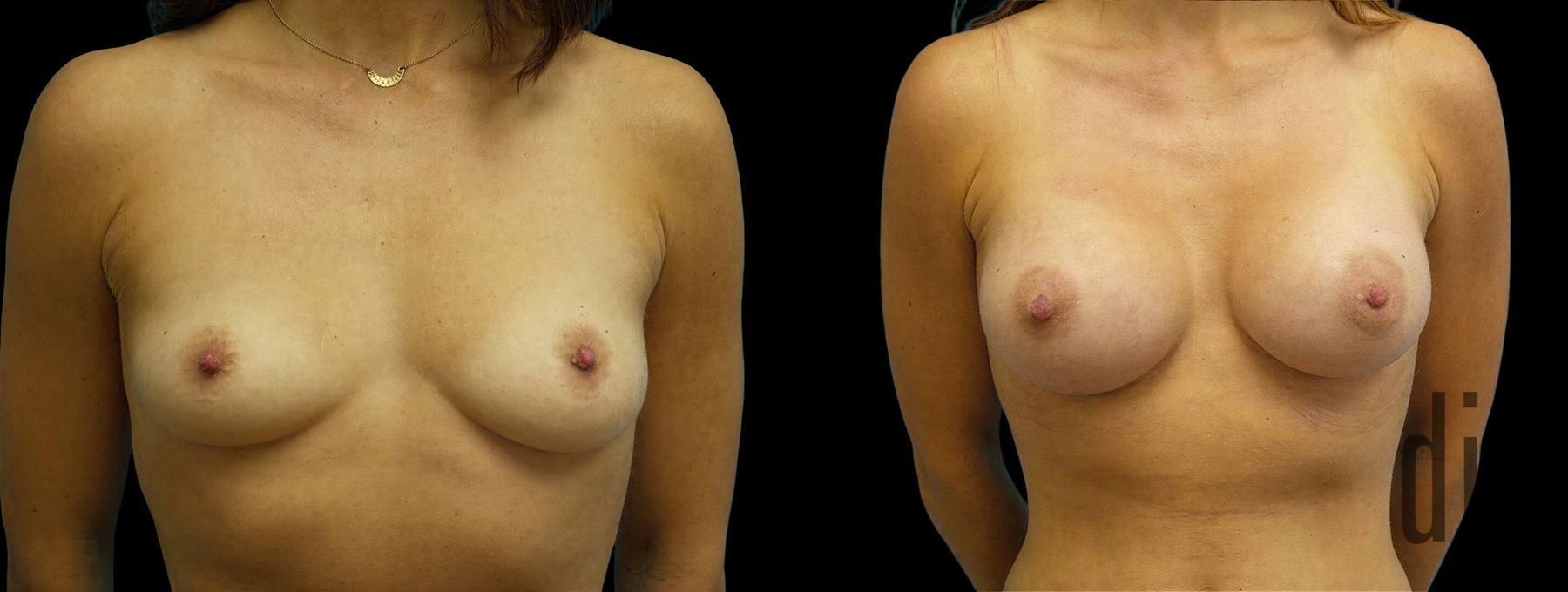 Before and after Breast Augmentation case 42998