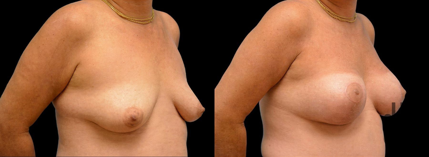 Before and after Breast Augmentation with Lift case 42781 - Angle 2