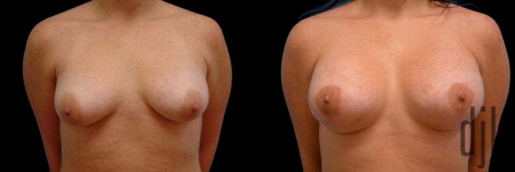 Before and after Breast Augmentation with Lift case 42725
