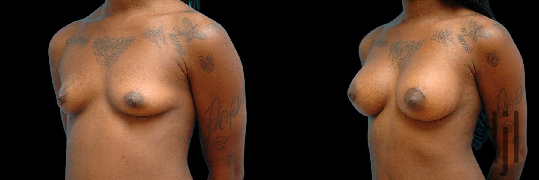 Before and after Breast Augmentation case 42765 - Angle 2
