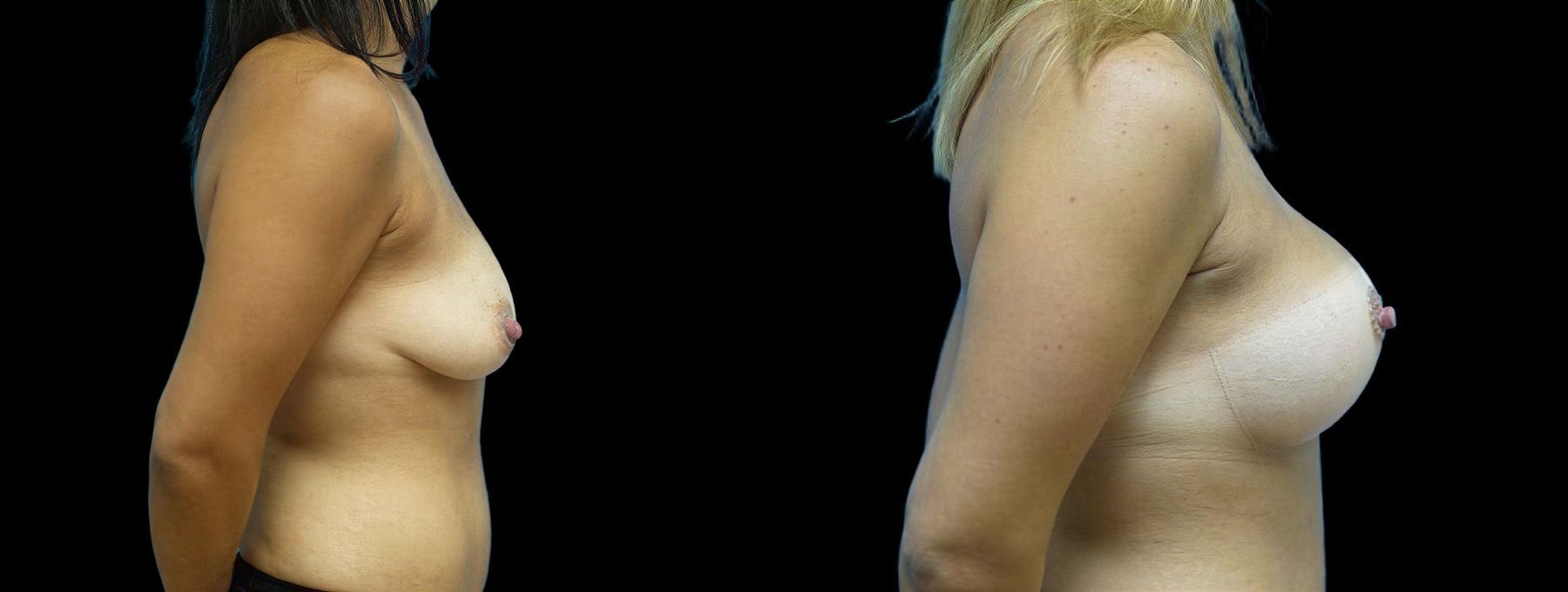 Before and after Breast Augmentation with Lift case 42802 - Angle 2