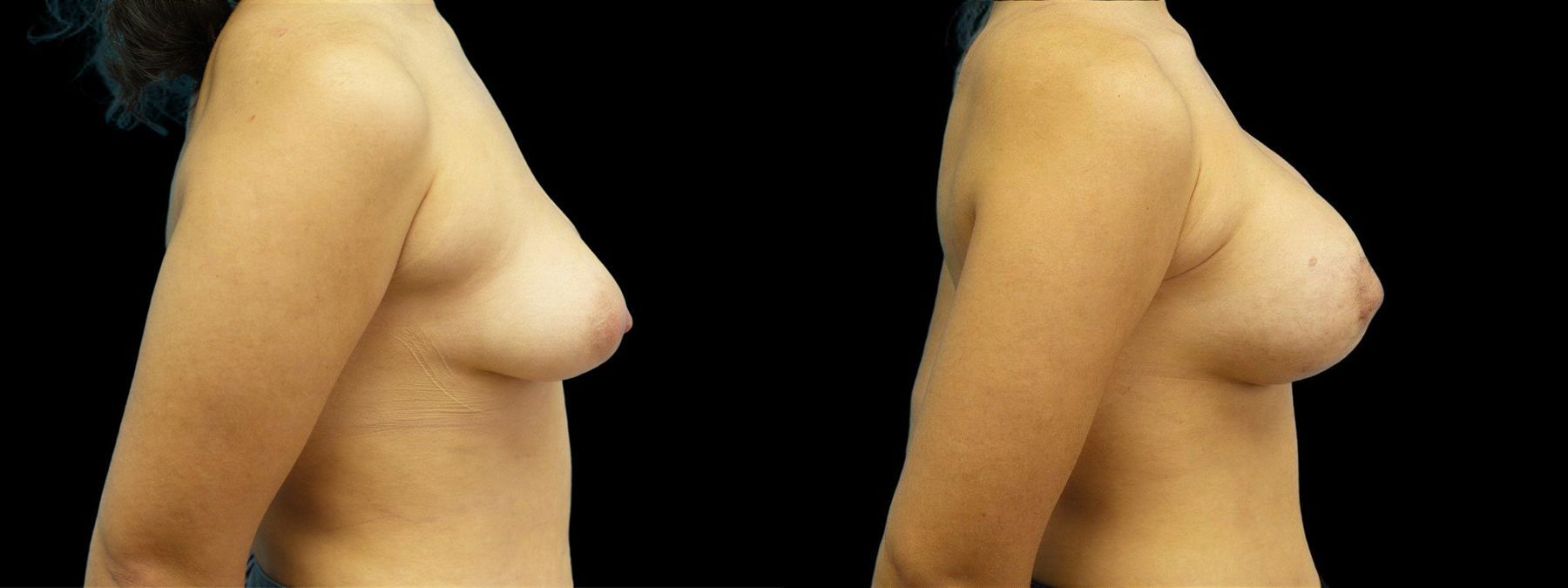 Before and after Breast Augmentation with Lift case 42908 - Angle 2