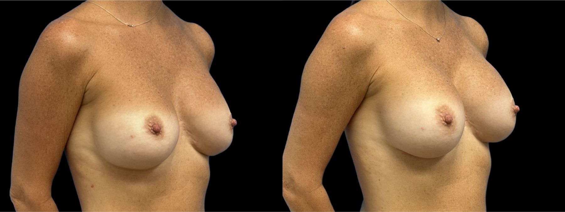 Before and after Breast Augmentation case 37366 - Angle 2