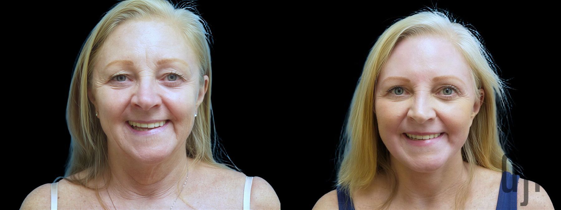 Before and after Facelift case 42784