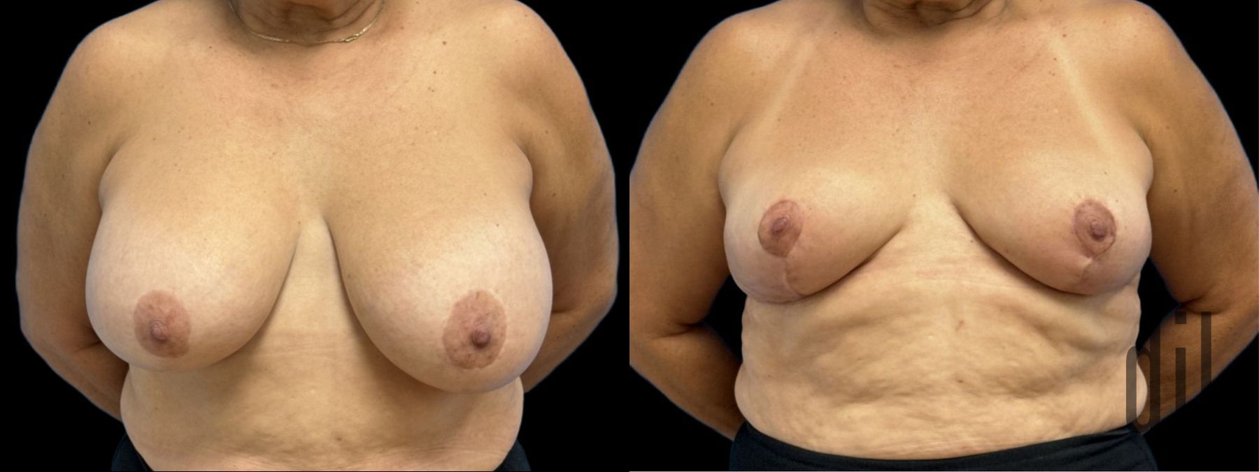 Before and after Explant Mastopexy case 41346