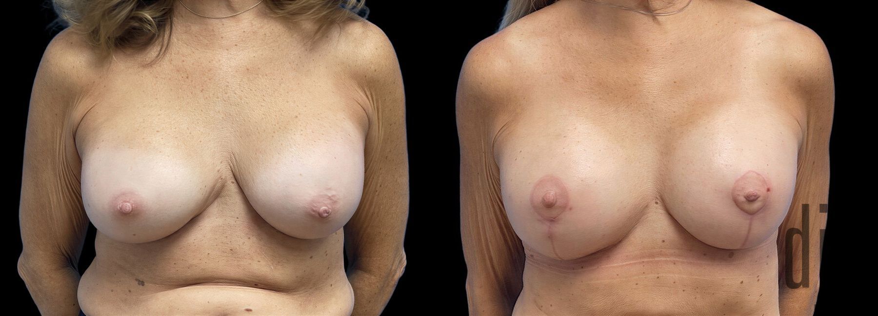 Before and after Implant Replacement Mastopexy case 43152
