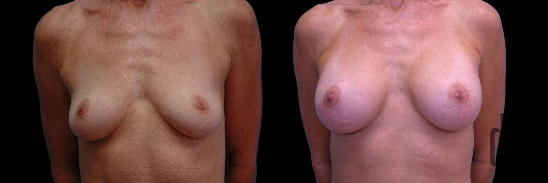 Before and after Breast Augmentation case 42867