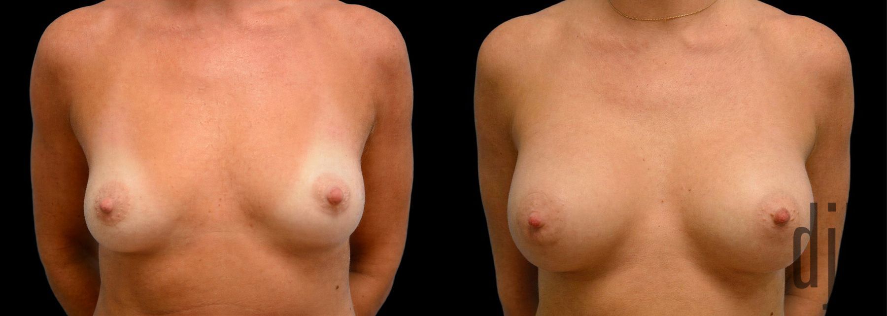 Before and after Breast Augmentation case 42849