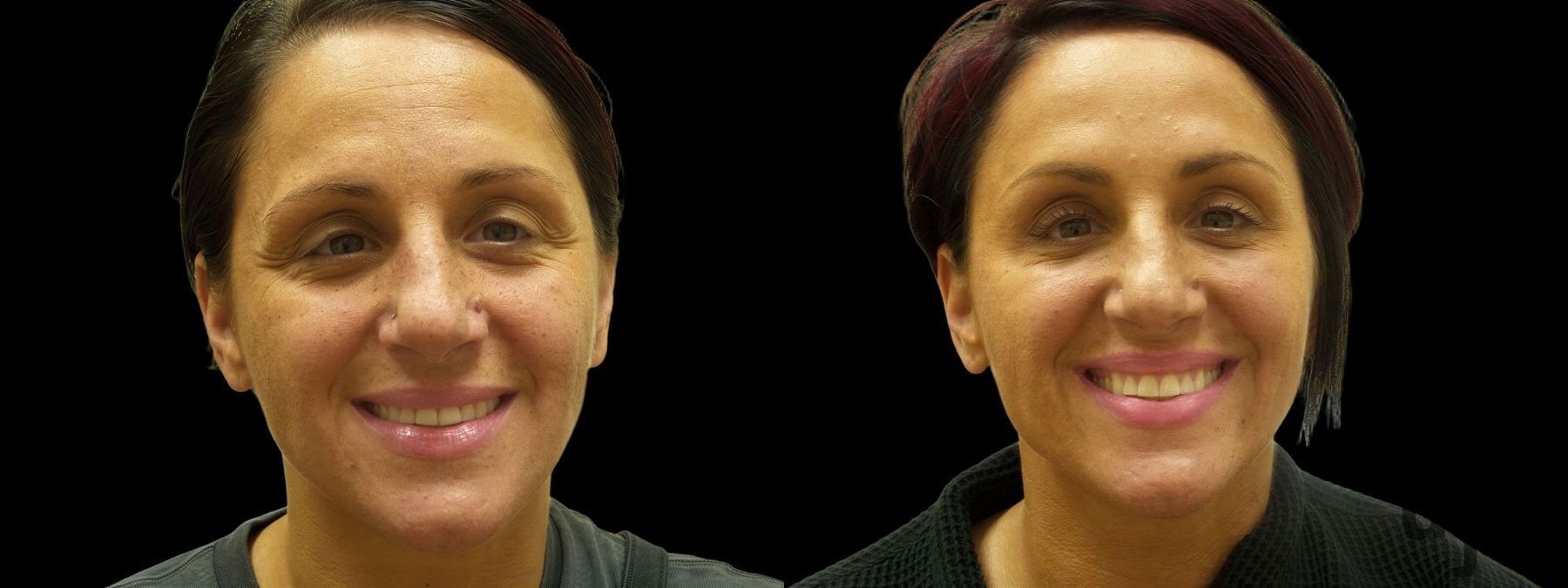 Before and after Suborbital / Tear Trough case 42604