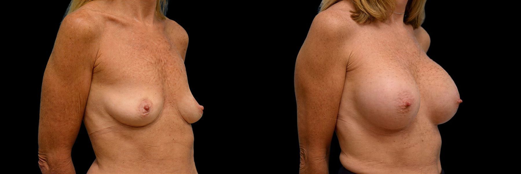 Before and after Breast Augmentation case 42888 - Angle 2
