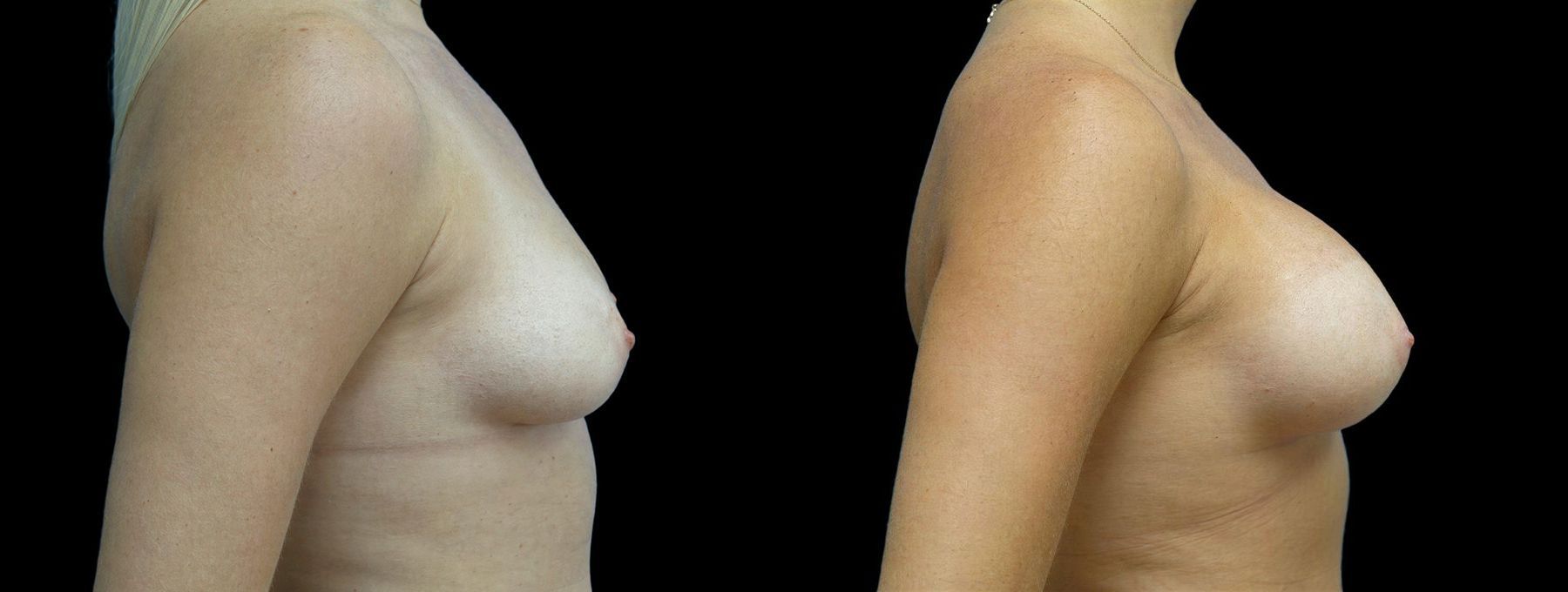 Before and after Breast Augmentation case 42932 - Angle 2
