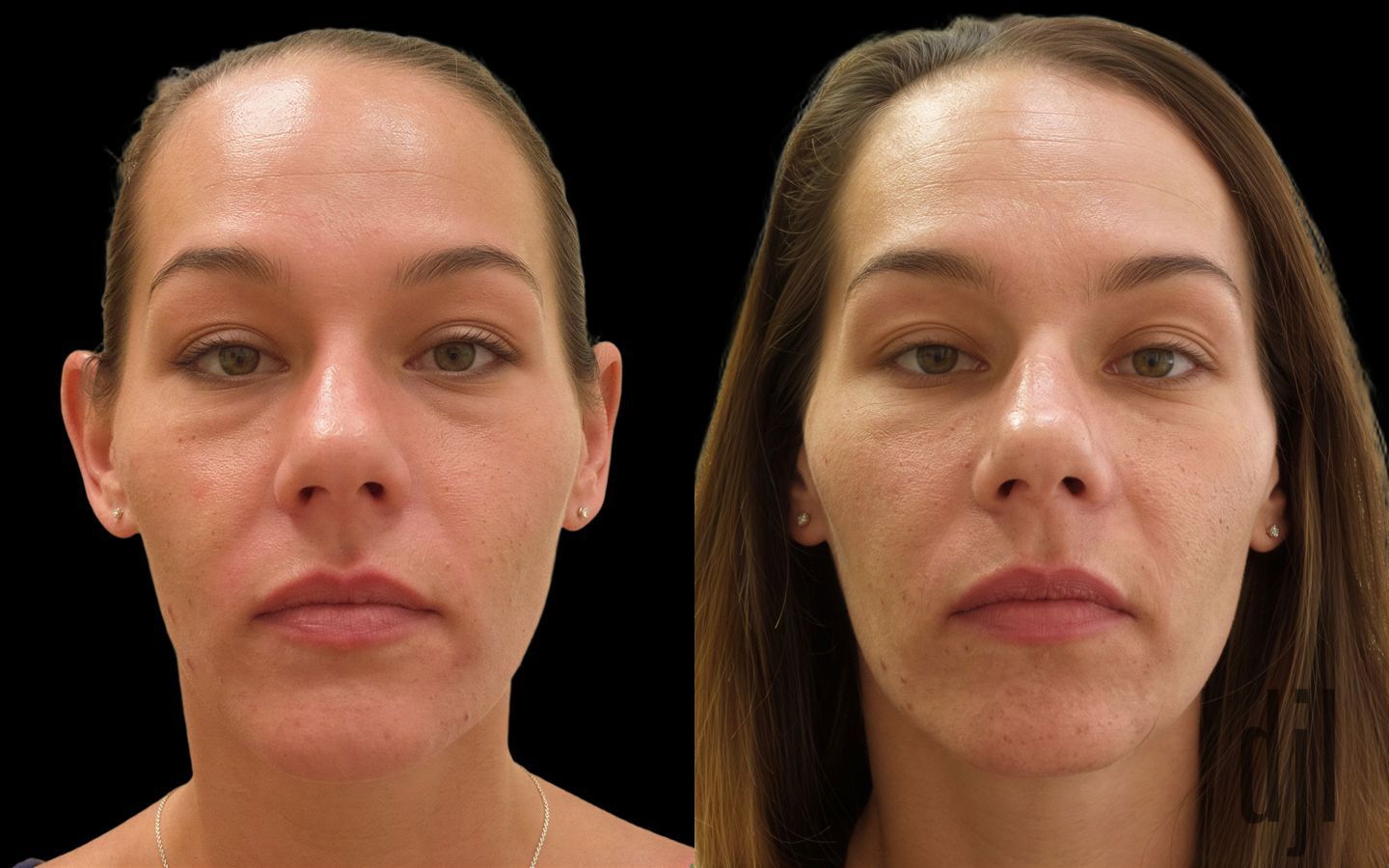 Before and after Suborbital / Tear Trough case 42630