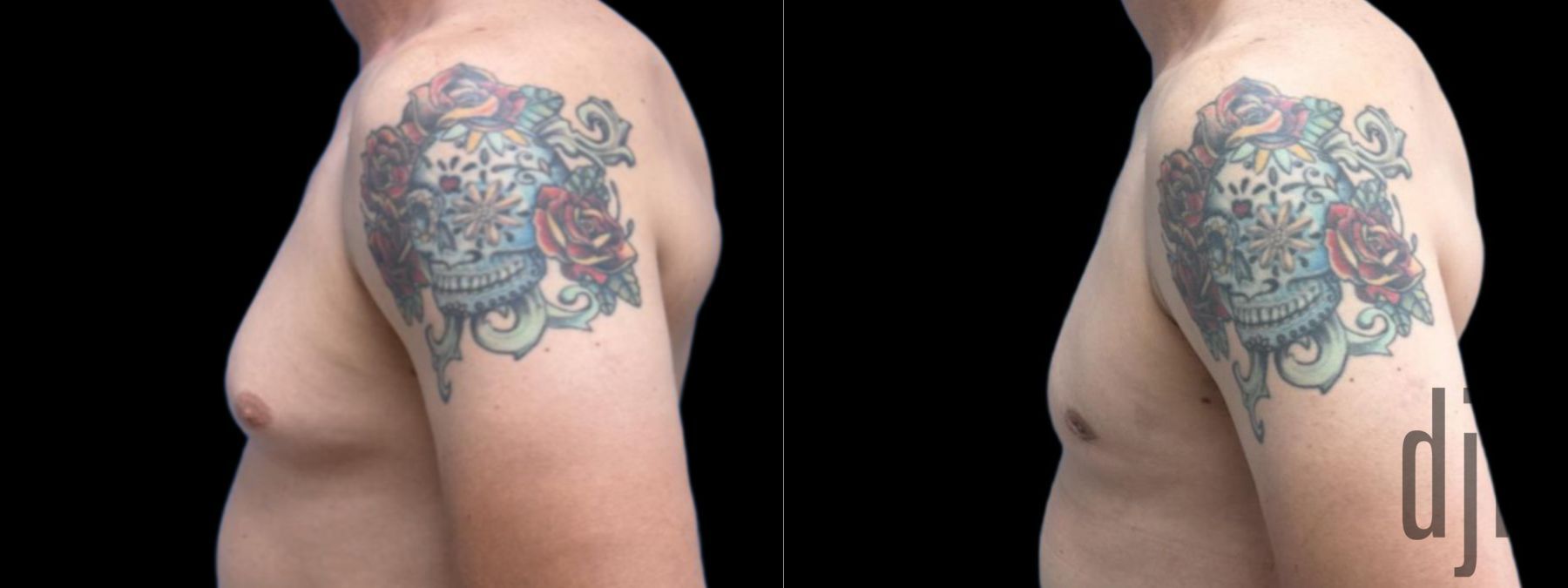 Before and after Gynecomastia case 37380 - Angle 2