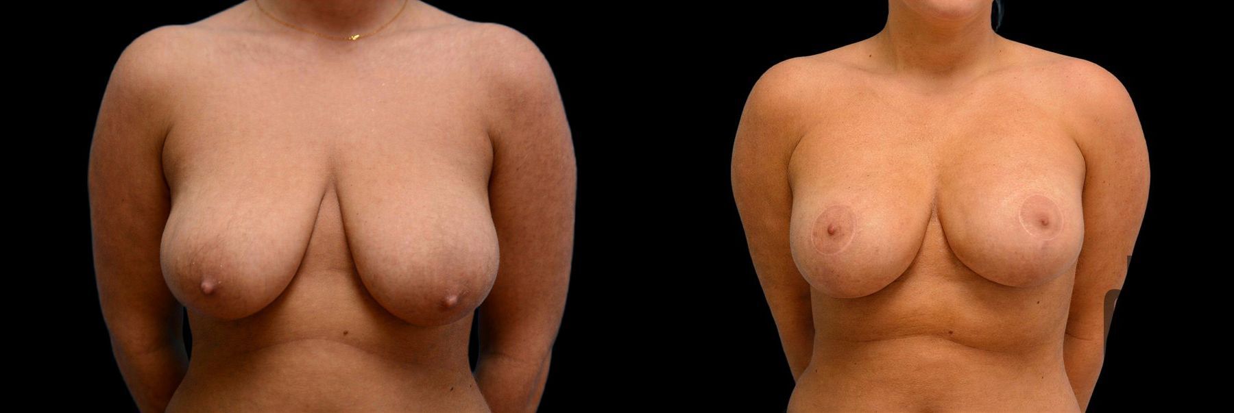 Before and after Breast Augmentation with Lift case 42738