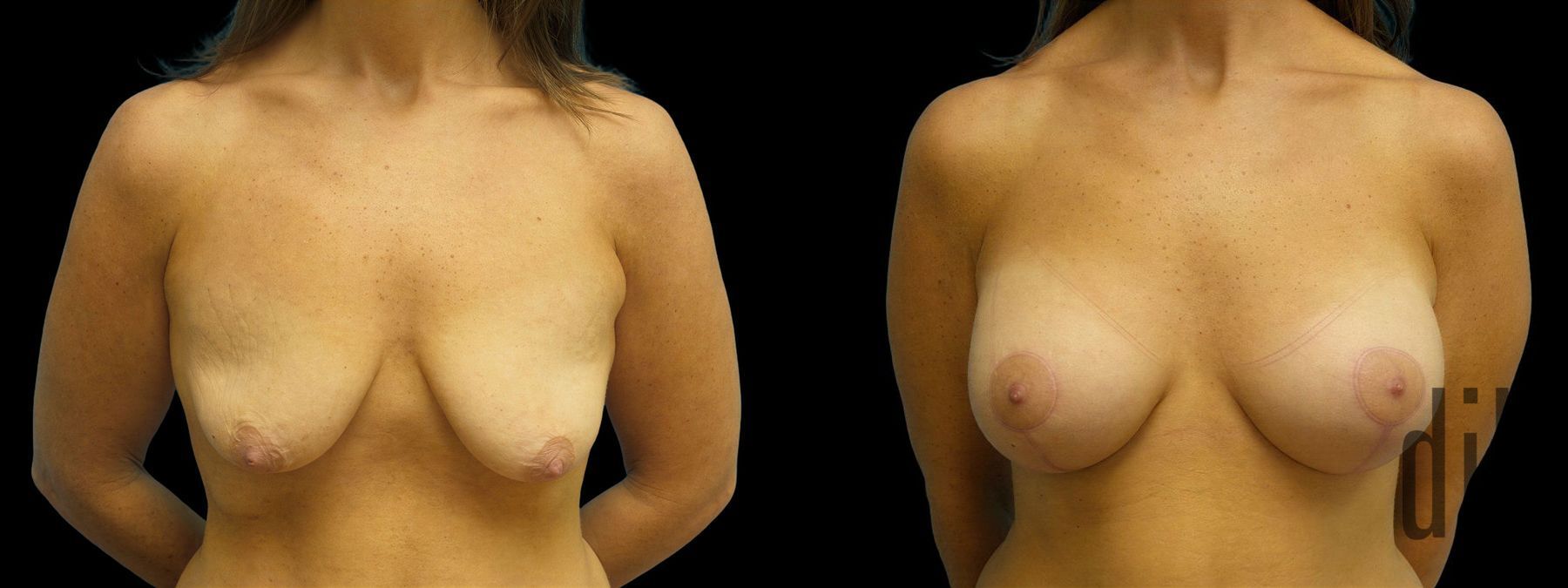 Before and after Breast Augmentation with Lift case 42894