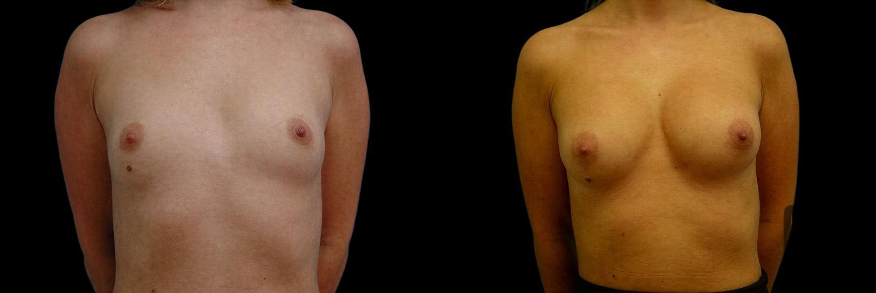 Before and after Breast Augmentation case 42785