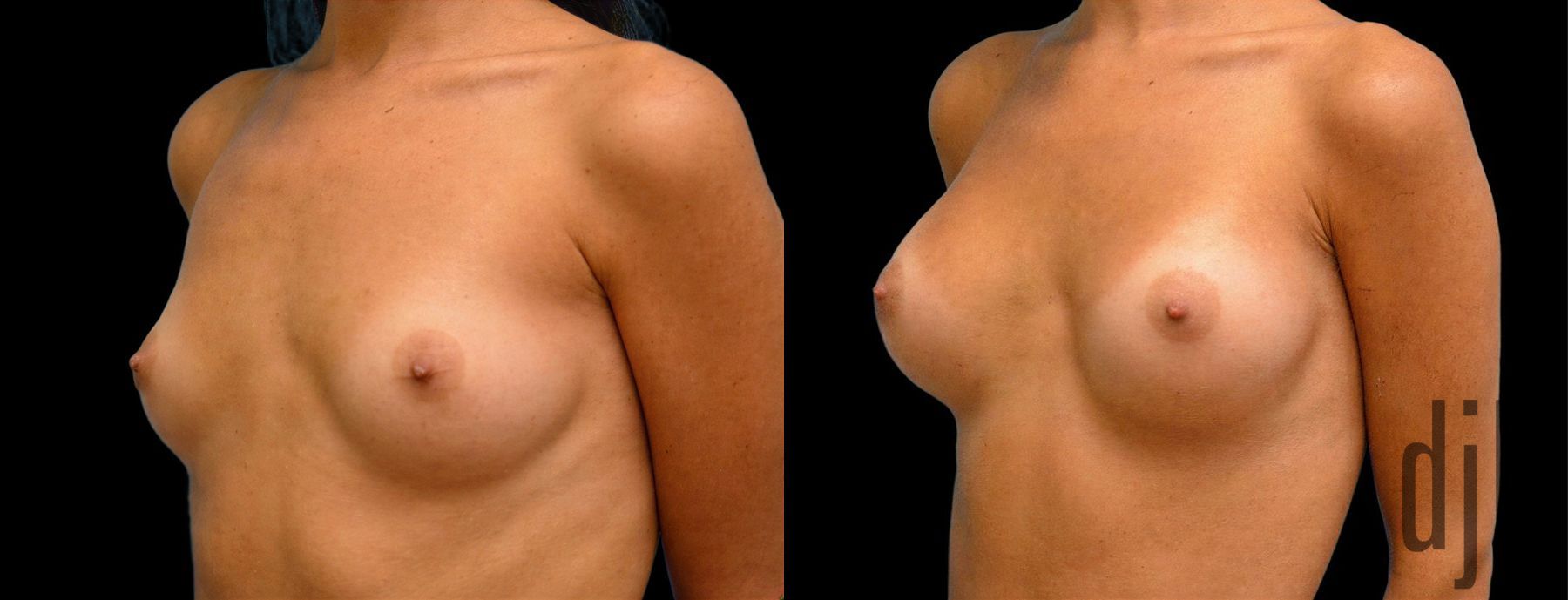 Before and after Breast Augmentation case 42863 - Angle 2