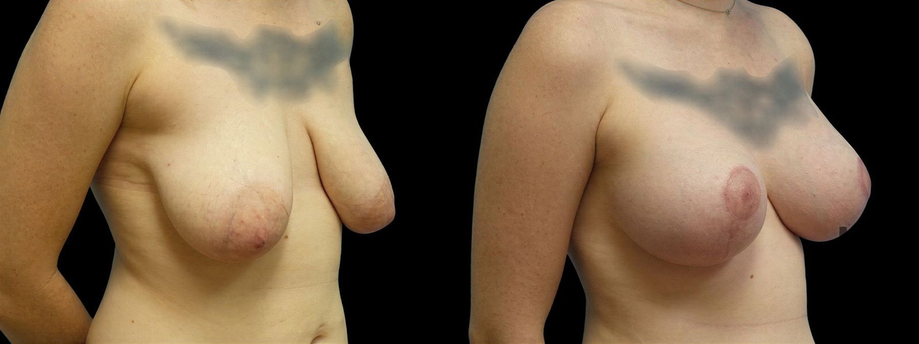 Before and after Breast Augmentation with Lift case 42955 - Angle 2
