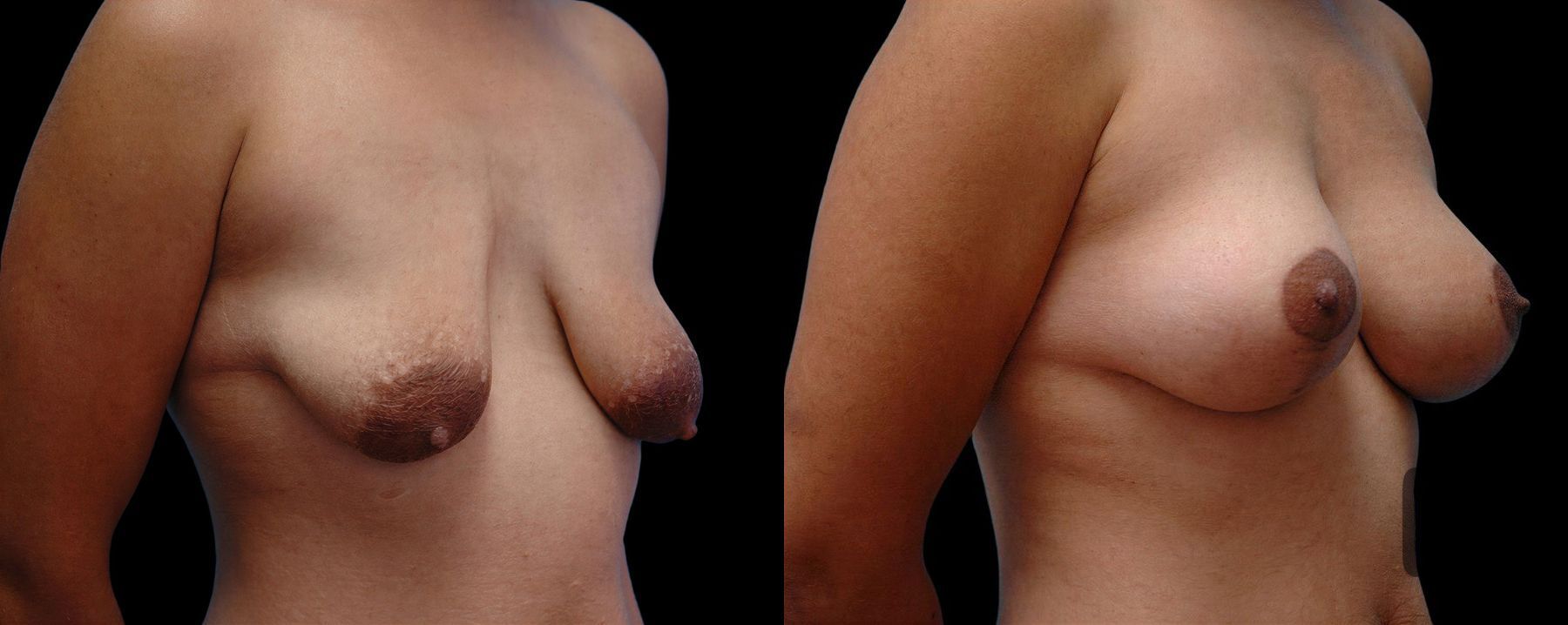 Before and after Breast Augmentation with Lift case 42659 - Angle 2