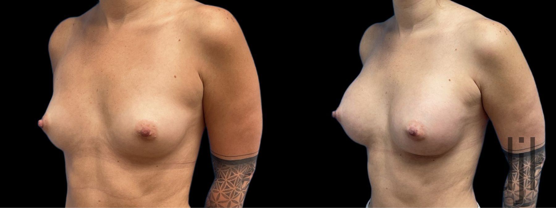 Before and after Breast Augmentation case 37381 - Angle 2