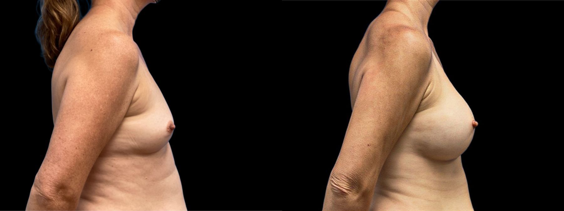 Before and after Breast Augmentation case 41241 - Angle 2