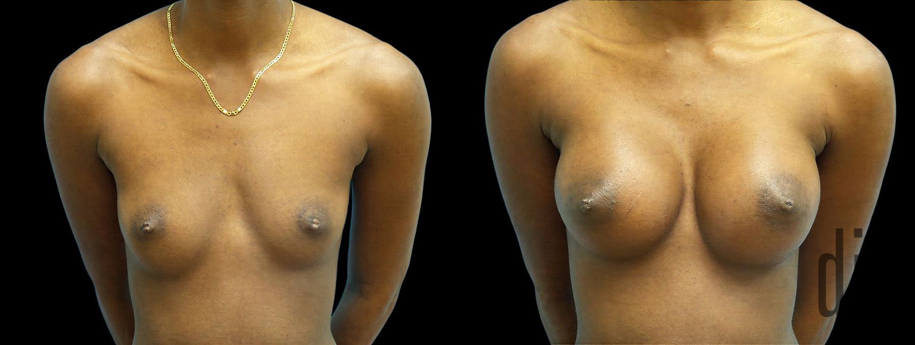 Before and after Breast Augmentation case 43007