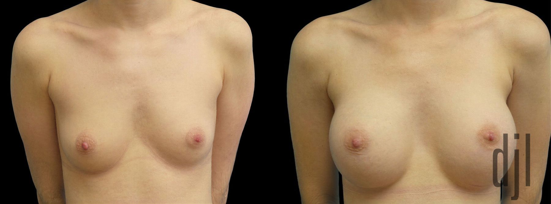 Before and after Breast Augmentation case 42967