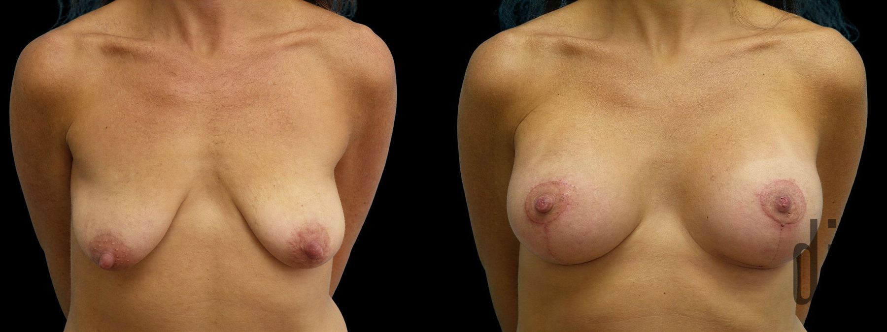 Before and after Breast Augmentation with Lift case 42854