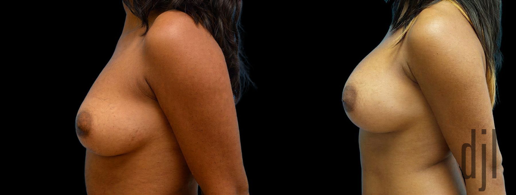 Before and after Breast Augmentation case 42915 - Angle 2