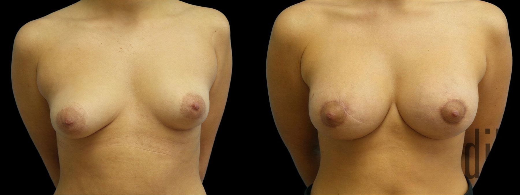 Before and after Breast Augmentation with Lift case 42908