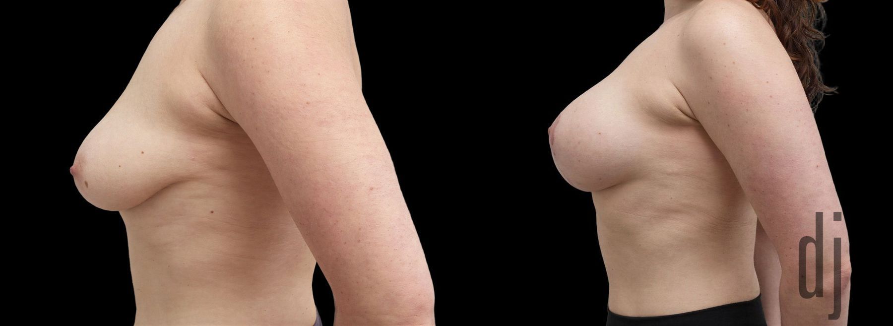 Before and after Breast Augmentation with Lift case 42965 - Angle 2