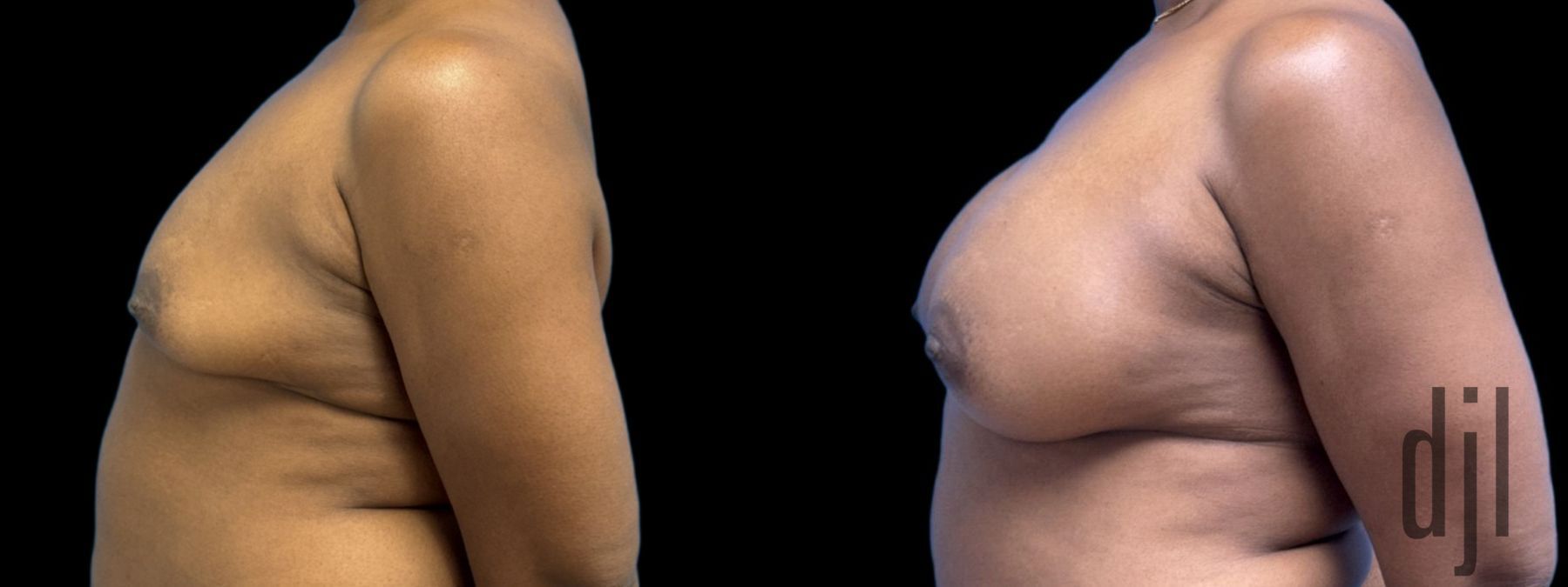Before and after Breast Augmentation case 37382 - Angle 2
