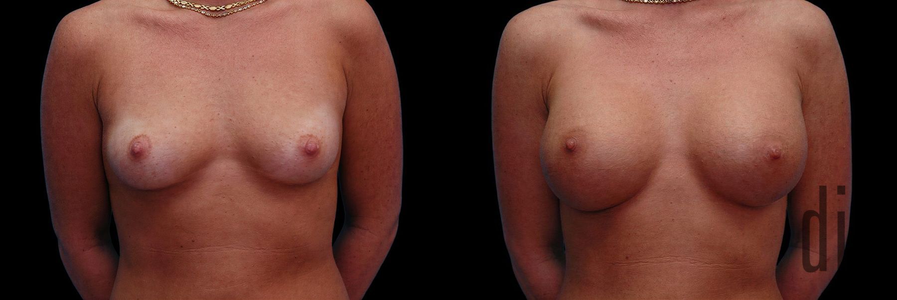 Before and after Breast Augmentation case 42570