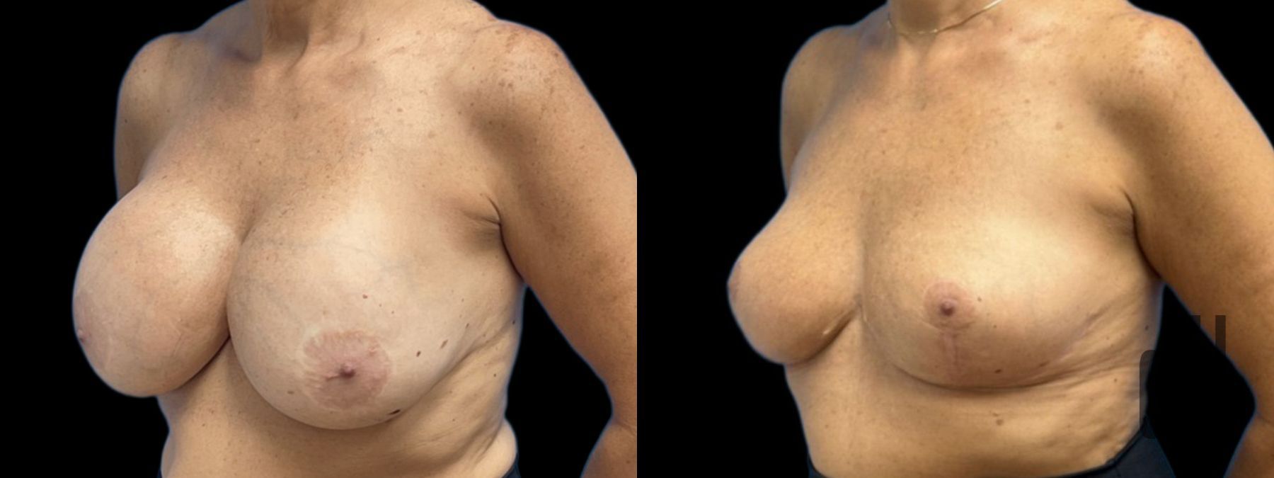 Before and after Explant Mastopexy case 37385 - Angle 2